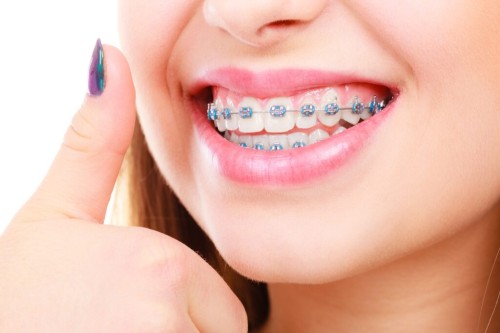 Traditional Braces