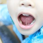 What Is a Lip and Tongue Tie Release and How Does It Work?