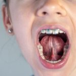 Child Needs Lip or Tongue Tie Release